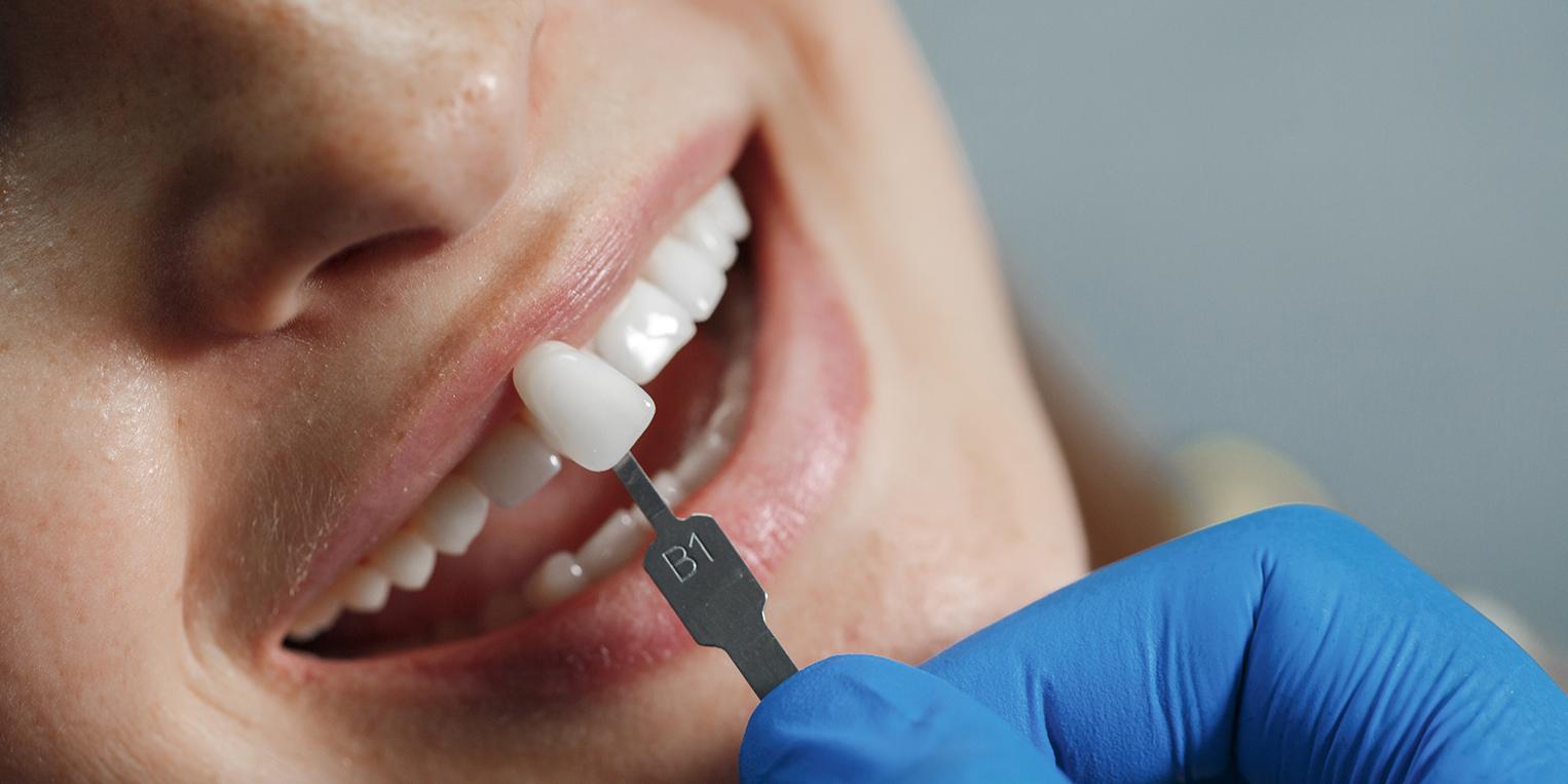 Implantes